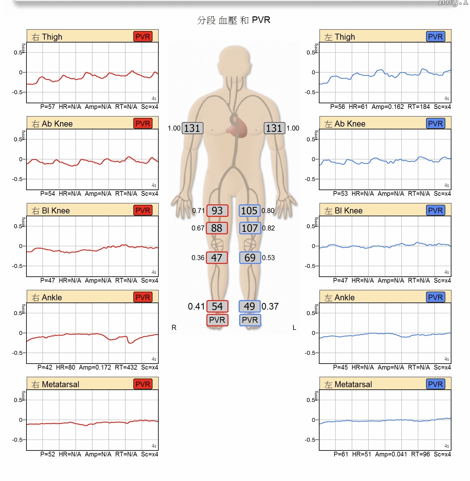 糖尿病足患者接受ABI與PVR下肢血液循環檢查