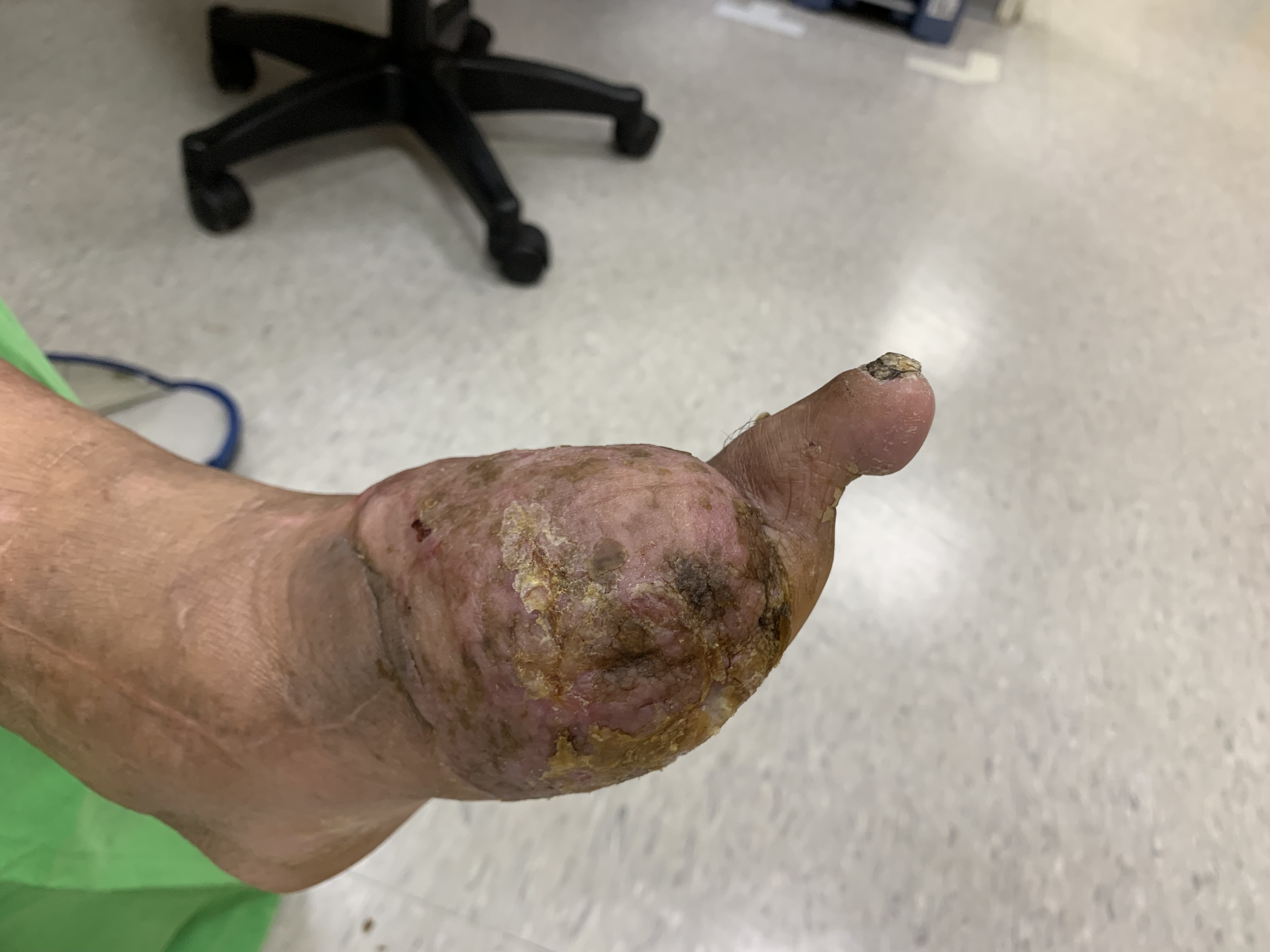 糖尿病足治療追蹤傷口影像