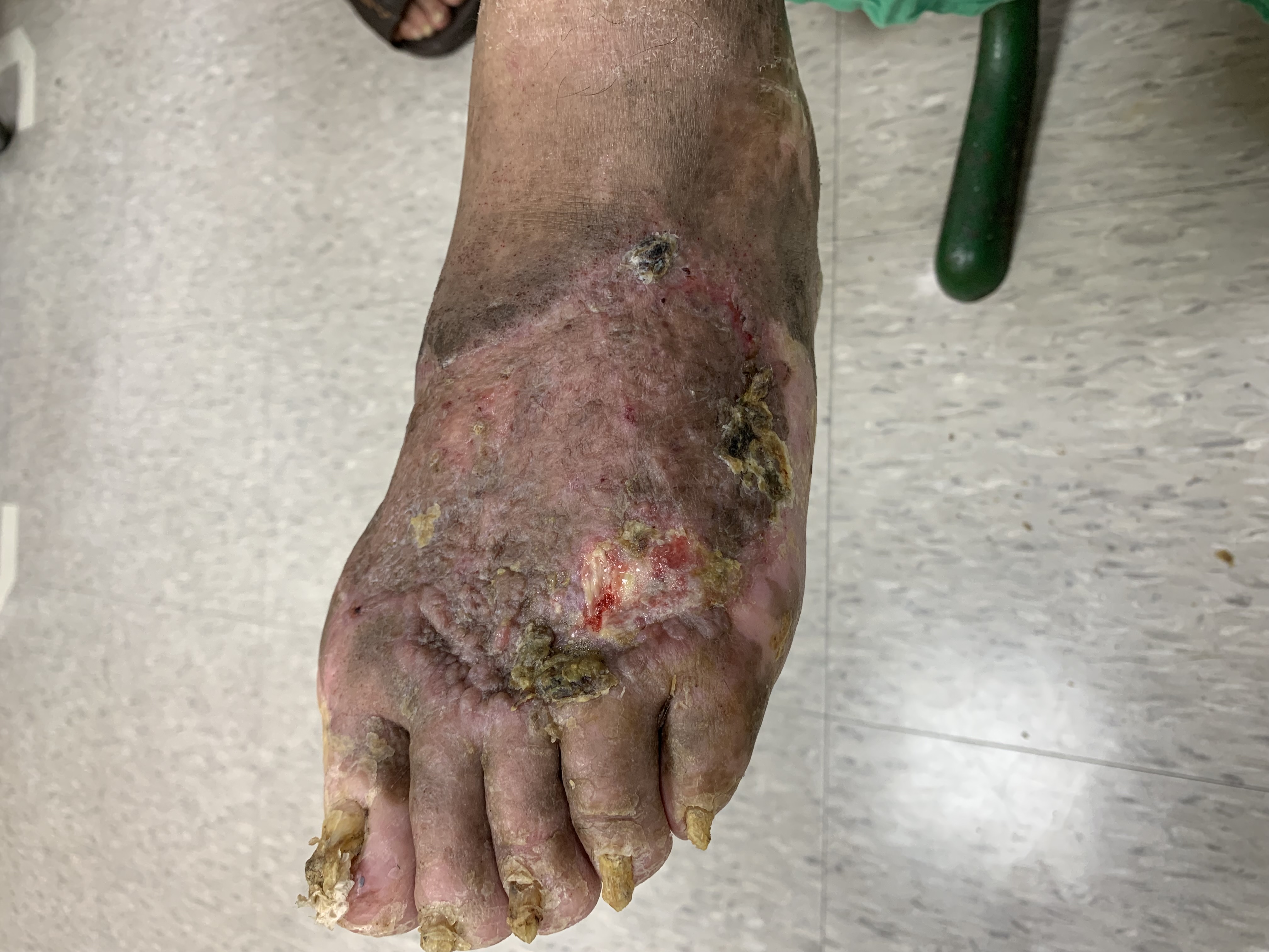 下肢慢性潰瘍治療追蹤傷口影像