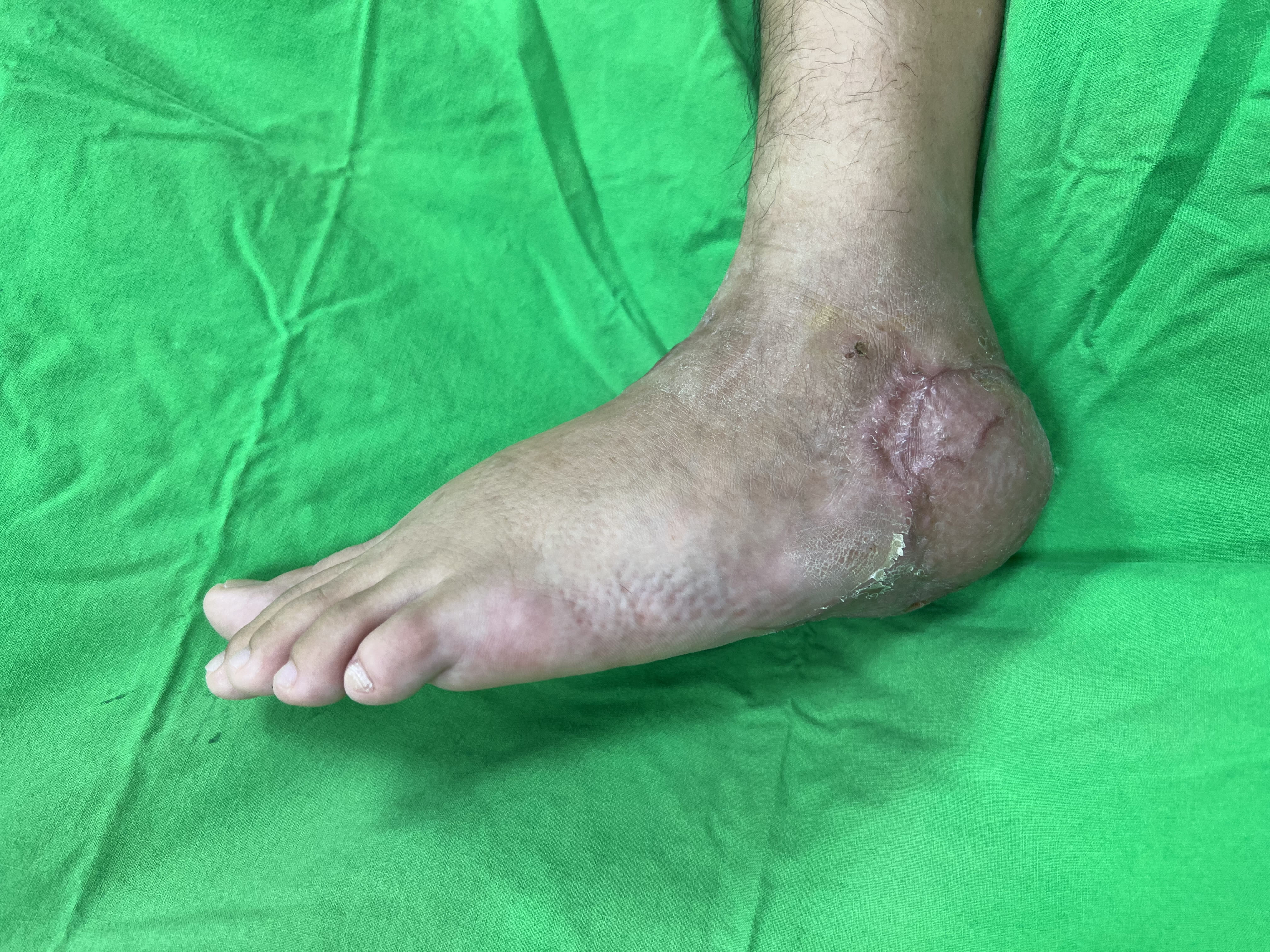 糖尿病足重建後足部側面輪廓