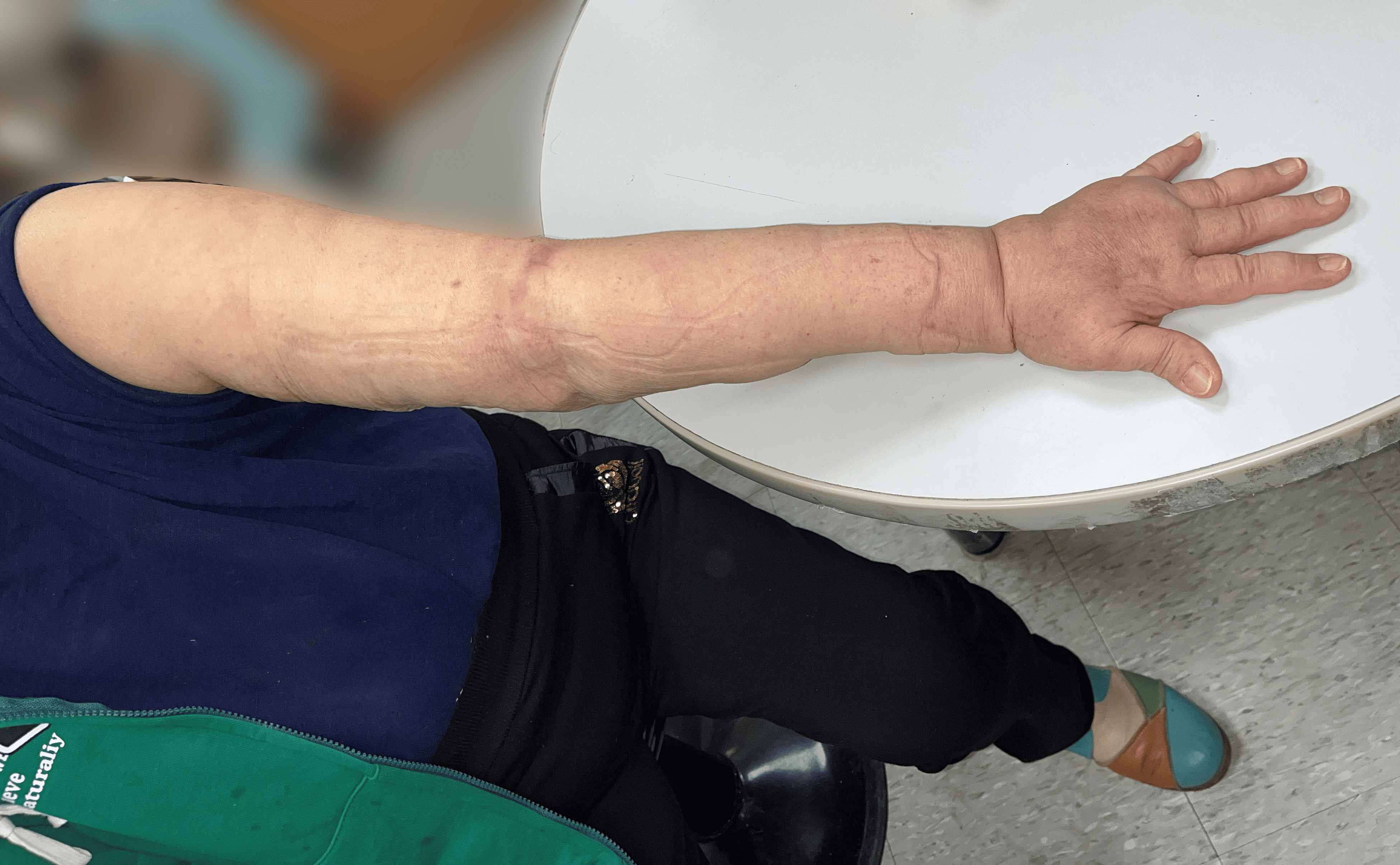 大林慈濟醫院整形外科帶血管游離淋巴結移植術後患肢照片