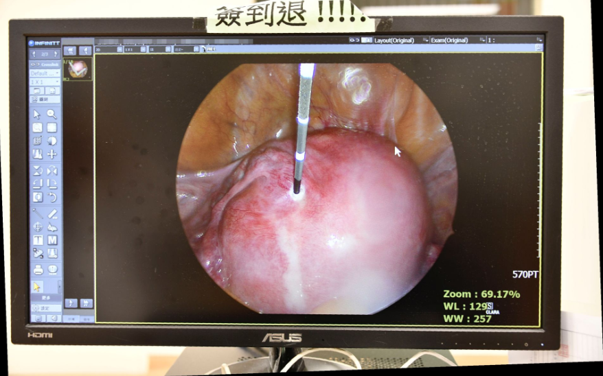 腹腔鏡下經腹部消融肌瘤