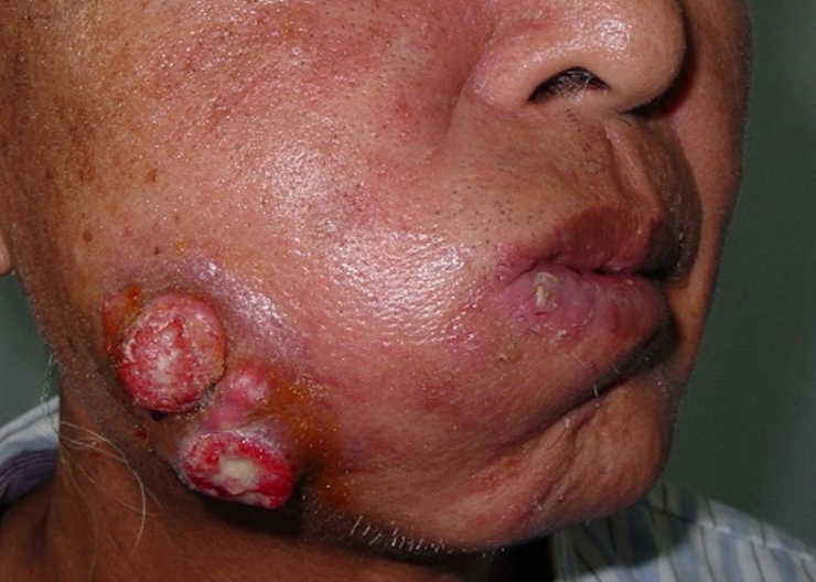 頭頸癌患者術前腫瘤位置及整形外科重建需求評估